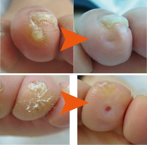 足の救急所ー巻き爪 タコ ウオノメ 角質 Himawari 瑞穂運動場西のその他の無料広告 無料掲載の掲示板 ジモティー
