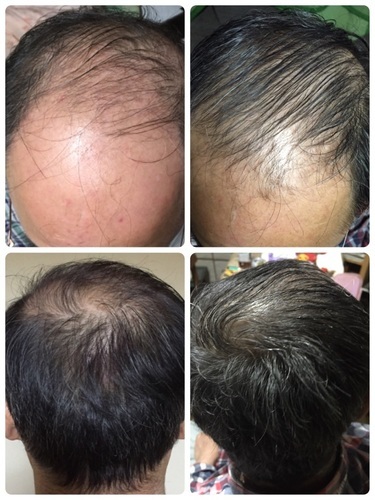 アルティバ成毛法99 8 髪を生やすのが仕事です うえちゃん 三軒茶屋のヘアサロンの無料広告 無料掲載の掲示板 ジモティー