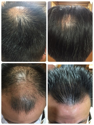 アルティバ成毛法99 8 髪を生やすのが仕事です うえちゃん 三軒茶屋のヘアサロンの無料広告 無料掲載の掲示板 ジモティー