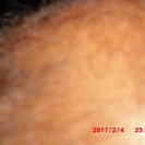 治験者　募集　ハリ治療で　発毛を促進