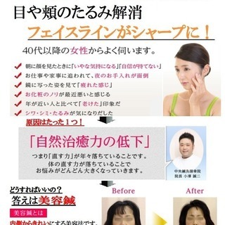 美容鍼１コイン体験会 ！５００円で美容鍼を体験できるチャンスです...