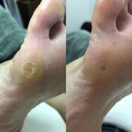 指 タコ の 痛い 足