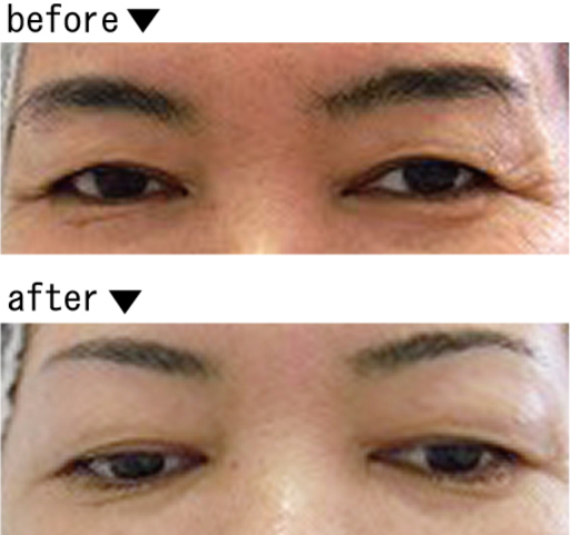 眉のワックス脱毛1 080円 コットンキャンディ 中頭のその他の無料広告 無料掲載の掲示板 ジモティー