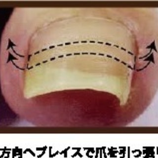 巻き爪でお悩みではありませんか？