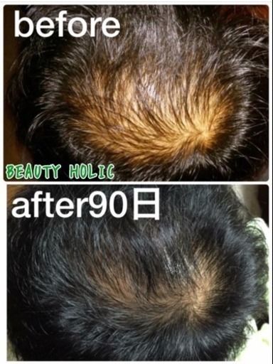 Tvでも話題の赤色led照射による育毛 発毛照射 Mi 千葉の美容の無料広告 無料掲載の掲示板 ジモティー