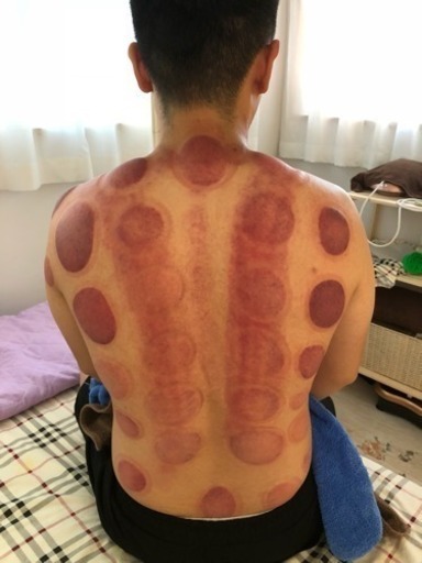 風邪や便秘にも効くダイエット効果高める 凄い威力の カッピング 茉莉 おもろまちのマッサージの無料広告 無料掲載の掲示板 ジモティー 風邪や便秘にも効くダイエット効果高める 凄い威力の カッピング 茉莉 おもろまちのマッサージの無料広告 無料掲載の掲示板 ジモティー