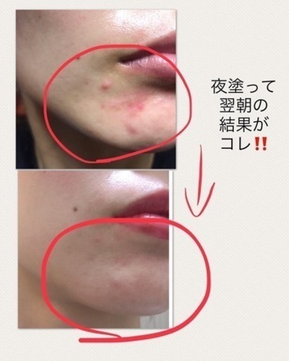 本気でニキビを治したい方‼️ニードル美容液★販売中