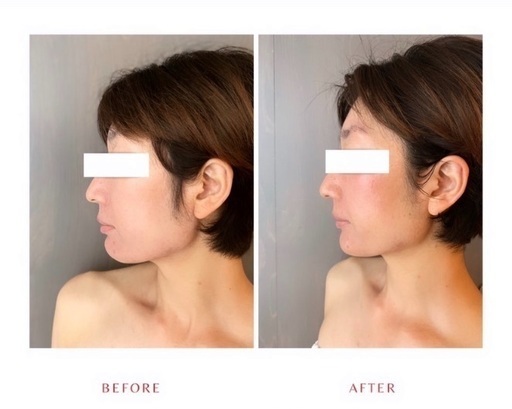 美肌再生専門サロンmou 痛くないハーブピーリング Mou式小顔術 Mou 代々木上原のエステの無料広告 無料掲載の掲示板 ジモティー