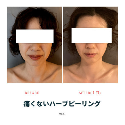 計器 覆す 筋肉の 顔 ピーリング エステ Angelical Web Jp 計器 覆す 筋肉の 顔 ピーリング エステ Angelical Web Jp