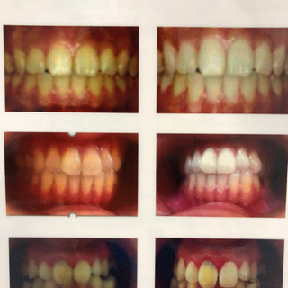 初回0円になる❗️セルフホワイトニング3回回数券