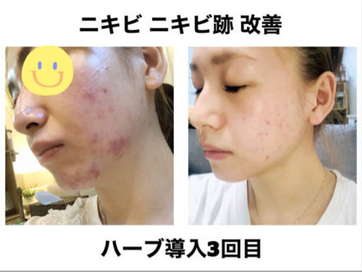 【オープン記念】剥離ありハーブピーリング10回分 オープン記念】剥離ありハーブピーリング10回分 （厳選】ハーブ