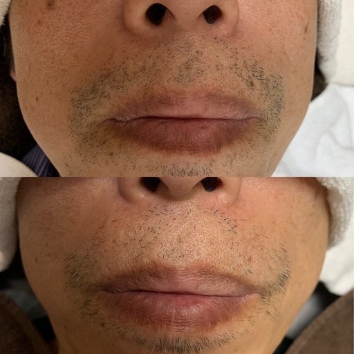 Revian オールハンド エステ 脱毛 まつげパーマ 花 京 国領のその他の無料広告 無料掲載の掲示板 ジモティー