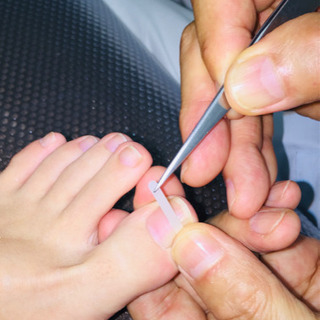 痛い巻爪❗️2回の施術で、凄い改善‼️ - ボディケア