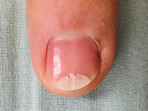 爪が割れてしまったら 割れ爪補強 あしまるくん 吉野町のボディケアの無料広告 無料掲載の掲示板 ジモティー