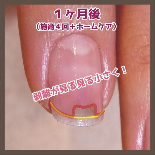 爪のお悩み解消 剥離 デコボコ爪でお悩みの方に ネイルサロンで解消できる最強ケア シシュ 高槻市のネイル の無料広告 無料掲載の掲示板 ジモティー