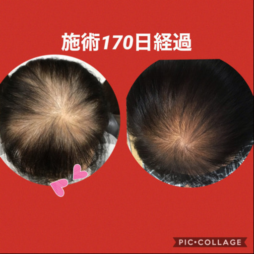 ヒト幹細胞培養液で美容室で育毛できます