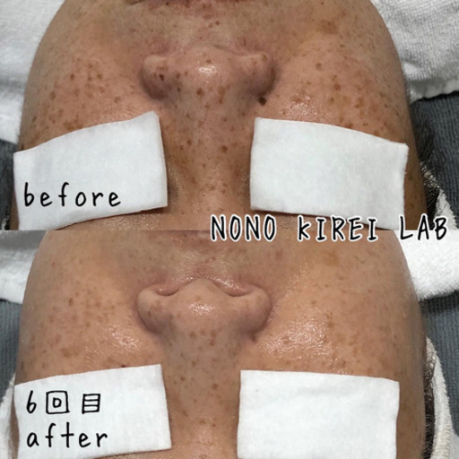 シミ そばかす ニキビ 毛穴の開き たるみが気になる方 フォトフェイシャル ジモティー 特価今だけ2回 6300円 税別 ノノキレイラボ 春日原のその他の無料広告 無料掲載の掲示板 ジモティー