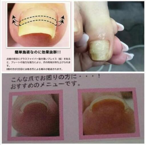 ネイルサロン 巻爪矯正 深爪矯正 Aby Nail 栗平のネイルの無料広告 無料掲載の掲示板 ジモティー