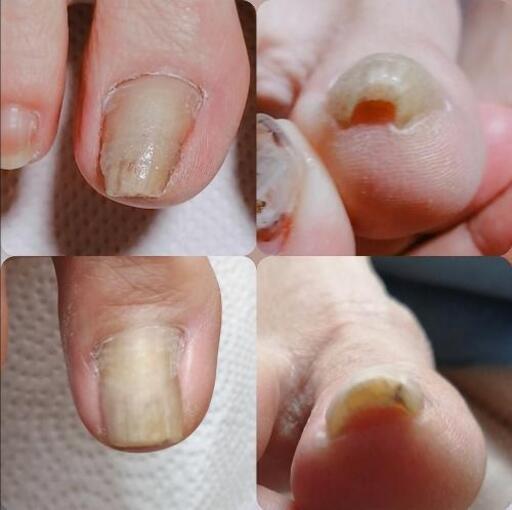 ネイルサロン 巻爪矯正 深爪矯正 Aby Nail 栗平のネイルの無料広告 無料掲載の掲示板 ジモティー