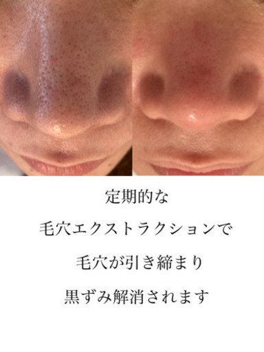 黒ずみ いちご鼻解消 那覇 毛穴レピア おもろまちの美容の無料広告 無料掲載の掲示板 ジモティー