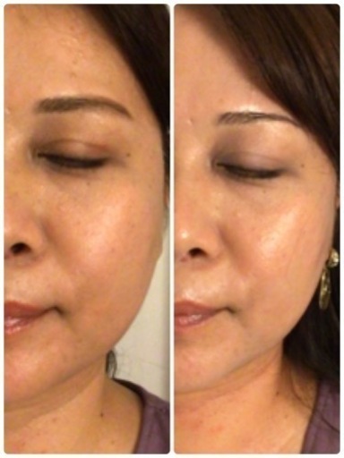 ハーブピーリング5回分 剥離なし（11月11日から2月20日の