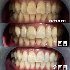 セルフホワイトニング【歯の黄ばみや口臭気になる方】