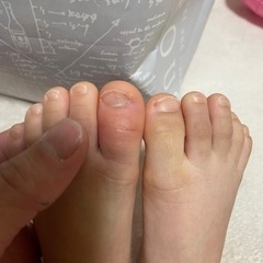 子供の足の指が。。。【追記しました！】