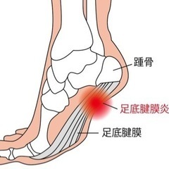 【足底筋膜炎、さまざまな腰痛】改善可能です❣️の画像