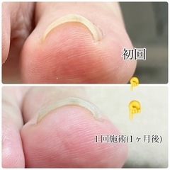 【人数限定】巻き爪ケアモニター募集のお知らせ