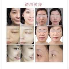 ハイフ HIFU 郵送可 美顔器 家庭用