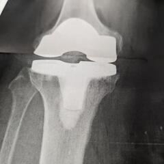 膝人工関節