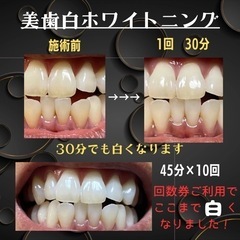沖縄県の虫歯ワースト1位をくつがえそう‼️歯のホワイトニングは虫...