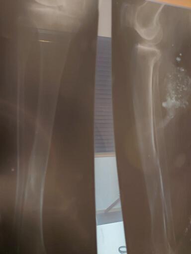 大腿骨のレントゲン写真