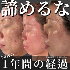 美容皮膚専科　LA NATURE 毛孔性苔癬/慢性ニキビ専門院