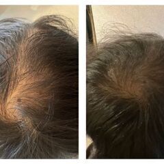 【抜け毛・薄毛改善】幹細胞エクソソームを使用した最新の頭皮…